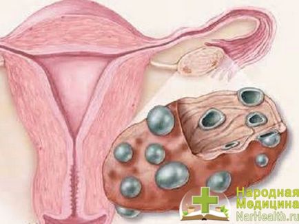 Хиперандрогения при жените - симптоми, причини, лечение на надбъбречната генезис