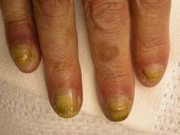 Гъбички на ноктите - Лечение народни средства против гъбички по ноктите на краката с ръцете и краката - на хартия
