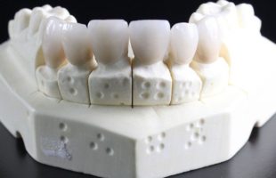 Какви са закачалките на зъбите и това, което правят