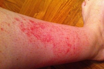 Как да се отървете от червени петна по краката след бръснене, защо те се появяват