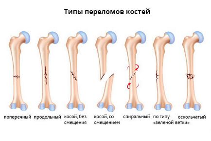 Как да се определи вредата или счупване okeydok (насинена) Как да се определи натъртване или фрактура, okeydok