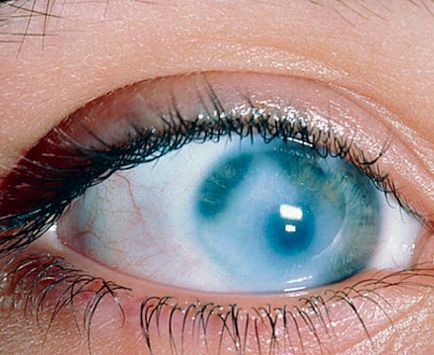 Как да се намали налягането на очите