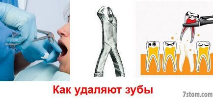 Както отстраняват зъби