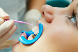Как да се засили и да възстановят зъбния емайл