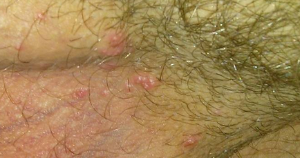 Какво е заразния молуск, и дали искате да го изтриете, образувания по кожата