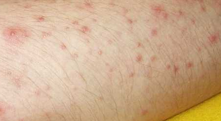 Какво е заразния молуск, и дали искате да го изтриете, образувания по кожата