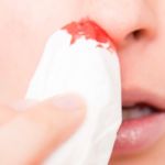 Как да причини кървене от носа бързо, безопасно и без болка