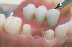 Как да вмъкнете зъбите, ако няма корен