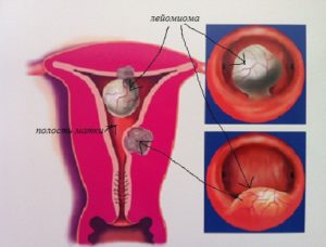 Калцирани миома на матката особености на лечение и развитие