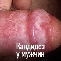 Кандидоза (млечница) - причини, симптоми, диагностика, лечение, усложнения и профилактика на гъбички