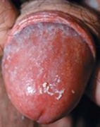 Кандидоза (млечница) - причини, симптоми, диагностика, лечение, усложнения и профилактика на гъбички