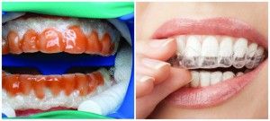 Уста охрана за избелване на зъбите у дома избелване