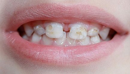 Млечен зъб кариес - първите признаци и методи на лечение