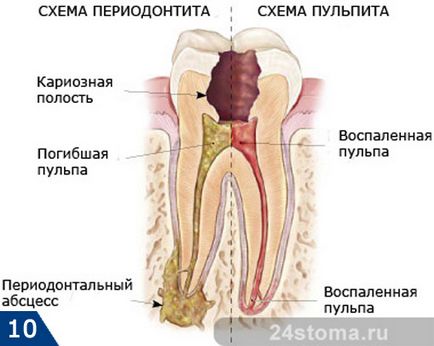 Зъбният кариес - снимка, причини, последствия