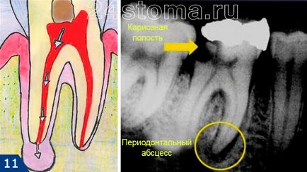 Зъбният кариес - снимка, причини, последствия