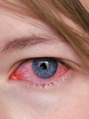 Кератит снимка на очите, симптоми, лечение и причинява херпесен кератит на очите, диагностика и