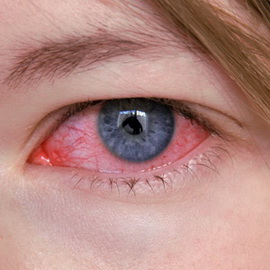 Кератит снимка на очите, симптоми, лечение и причинява херпесен кератит на очите, диагностика и