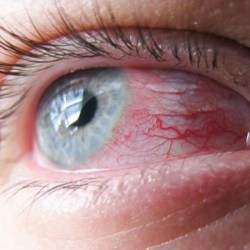 Кератит симптоми и лечение на окото и на традиционните народни средства за защита