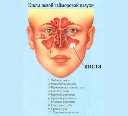 Киста на горна челюст (максиларен) синусите симптоми и лечение