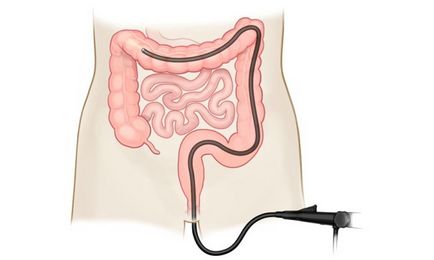 Колоноскопия - болен или не се подложи на процедурата, и как да се подготвим за него