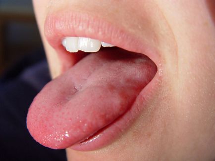 Кафяви петна по причини на езика и лечение