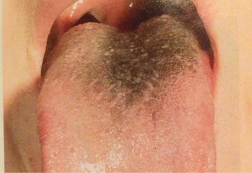 Кафяви петна по езика, при възрастни причини и лечение