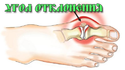 Костите на големите пръсти - лечение, лечение у дома