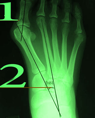 Костите на големите пръсти - лечение, лечение у дома