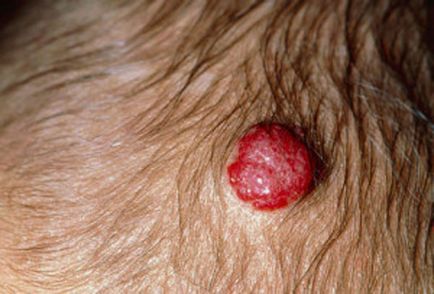Червени родилни петна - тяло, на причините за сигнални опасни заболявания, фото