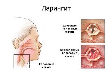 Ларингит при деца - причини, симптоми и лечение