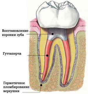 Кореново лечение, почистване и пълнене канали и корените на зъбите