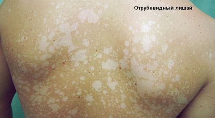 Pityriasis лишей медикаментозни лечение и народни средства