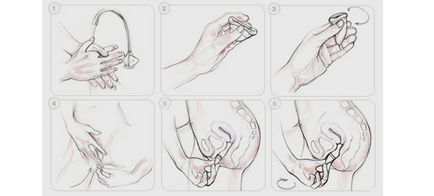 Менструалният чаша (ОСП) инструкция, моят гинеколог
