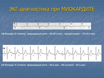 Миокардит сърце - какво е това, причини, последствия, МКБ-10