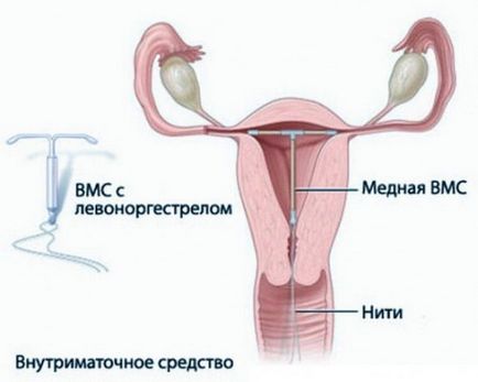 Миома на матката - признаци, симптоми, лечение