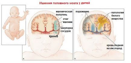 мозъка neurosonography новородени (grudnichka) какво е, до каква възраст