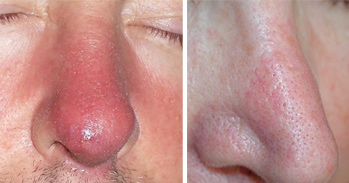 Червен нос причинява, лечение на народната медицина