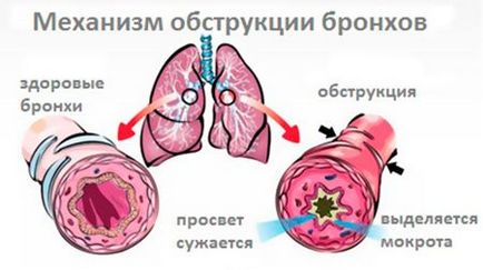 Обструктивен бронхит при децата народната медицина, лекарства