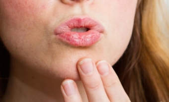 Напукани устни - лечение у дома, отколкото да се намажете