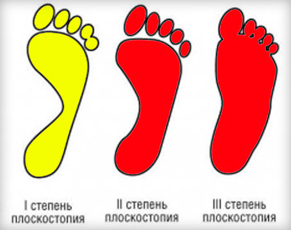 Ортопедични обувки за жени (лято, зима и вътрешни), как да избират кога и валгус деформация