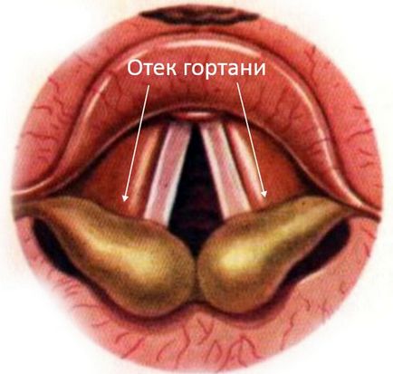 Подуване на гърлото - причини, признаци, симптоми и лечение