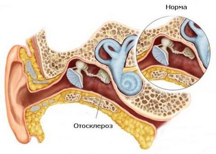 Отосклероза причини, симптоми, лечение, otospongioza