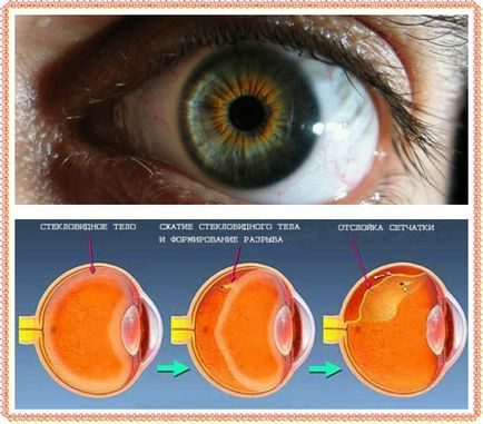 отлепване на ретината води до по-добро лечение на и