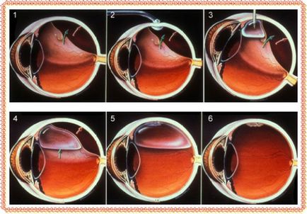 отлепване на ретината води до по-добро лечение на и