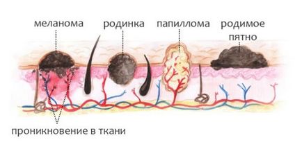 Папиломен в симптоми и лечение на детето