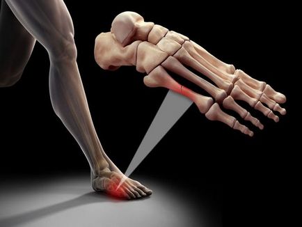 Фрактура на малкия пръст на крака си признаци, симптоми и лечение на народната медицина