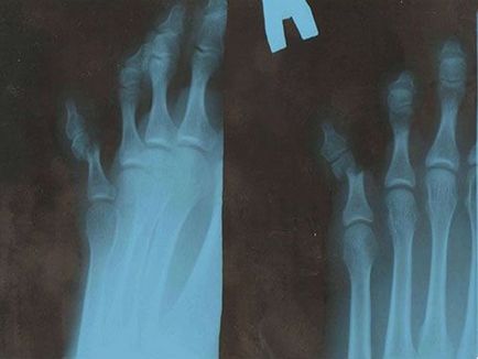 Фрактура на малкия пръст на крака си признаци, симптоми и лечение на народната медицина