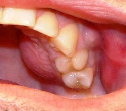 Периостити челюст - лечение на възпаление на лекарствата от народната медицина надкостница за зъби