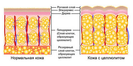 Подкожно мастна тъкан (хиподерма) и причинява целулит