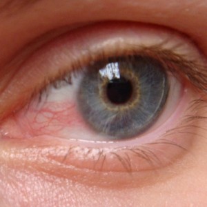 Почервеня бяло на окото - основните причини за възпаление